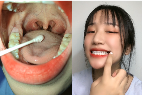 小美女拿棉签捅嗓子检查过程3V自拍视频【百度网盘下载】-阿黑颜